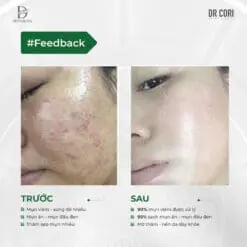 Ampoule đặc trị mụn DR PLUSCELL ACNE SPOT Hộp 10 lọ 10 550474808 1108216858091139 251319166900210259 n
