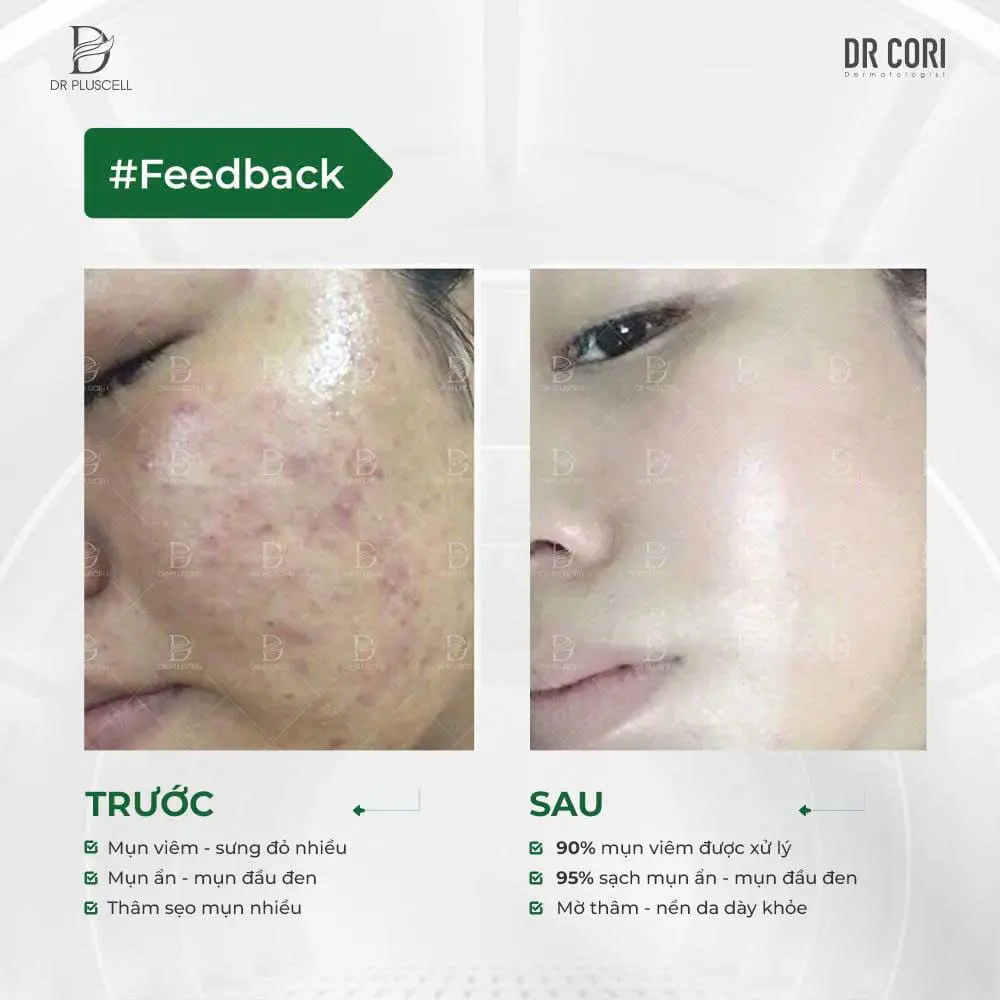 Ampoule đặc trị mụn DR PLUSCELL ACNE SPOT Hộp 10 lọ 5 Ampoule đặc trị mụn DR PLUSCELL ACNE SPOT Hộp 10 lọ - Ảnh 5