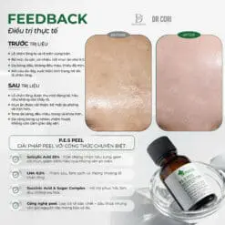 Peel Trị Mụn BHA DR Pluscell 20% triệt dầu trẻ hoá da PES PEEL 8 650350013 1242684884644335 313499668804042012 n