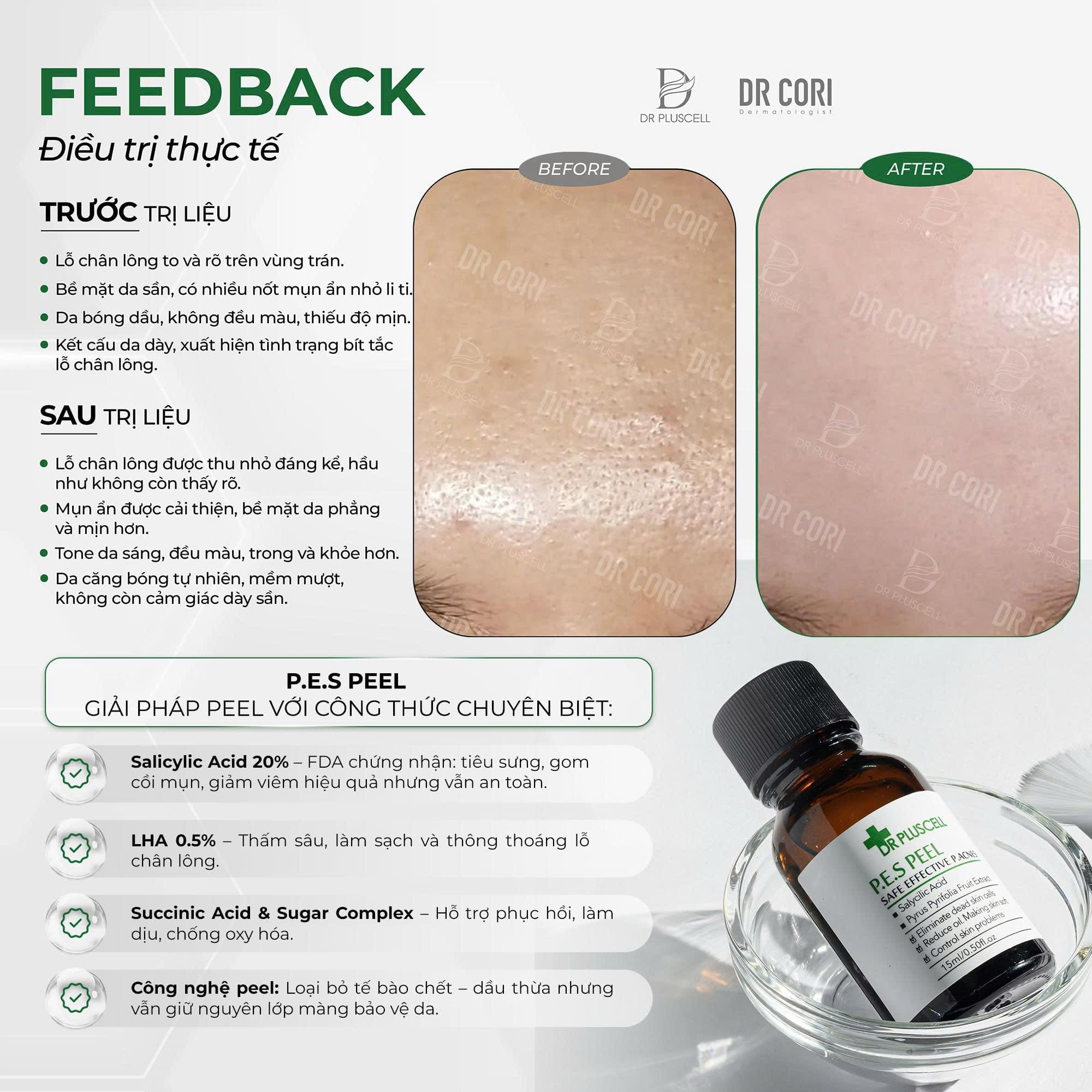 Peel Trị Mụn BHA DR Pluscell 20% triệt dầu trẻ hoá da PES PEEL 3 Peel Trị Mụn BHA DR Pluscell 20% triệt dầu trẻ hoá da PES PEEL - Ảnh 3